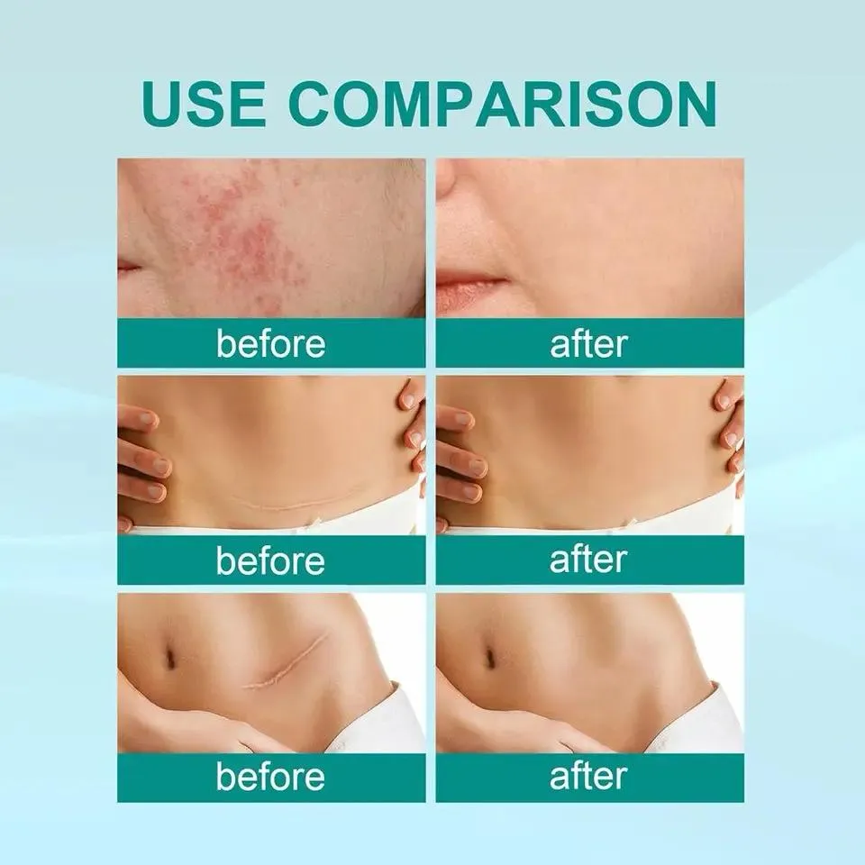 Scar Removal Spray Fade Scar -20g